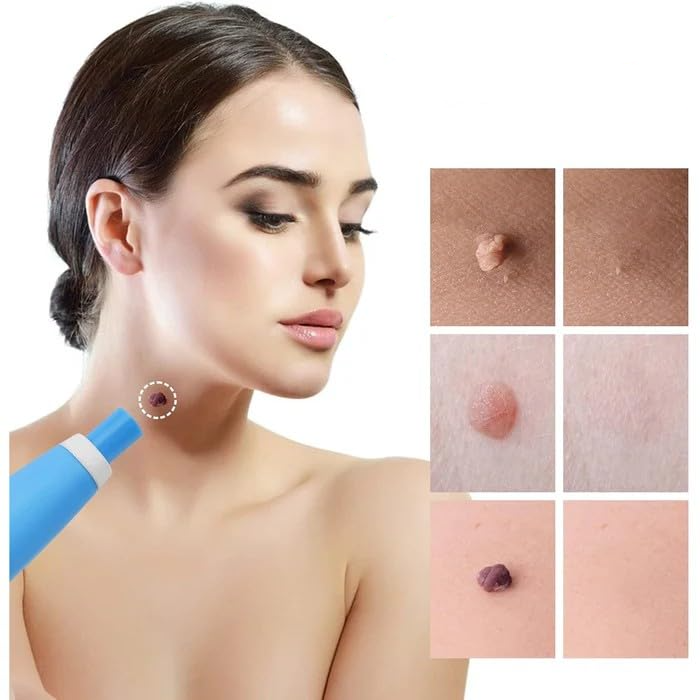 Skin Spot Removal Kit Painless Applicator Silicone Bands