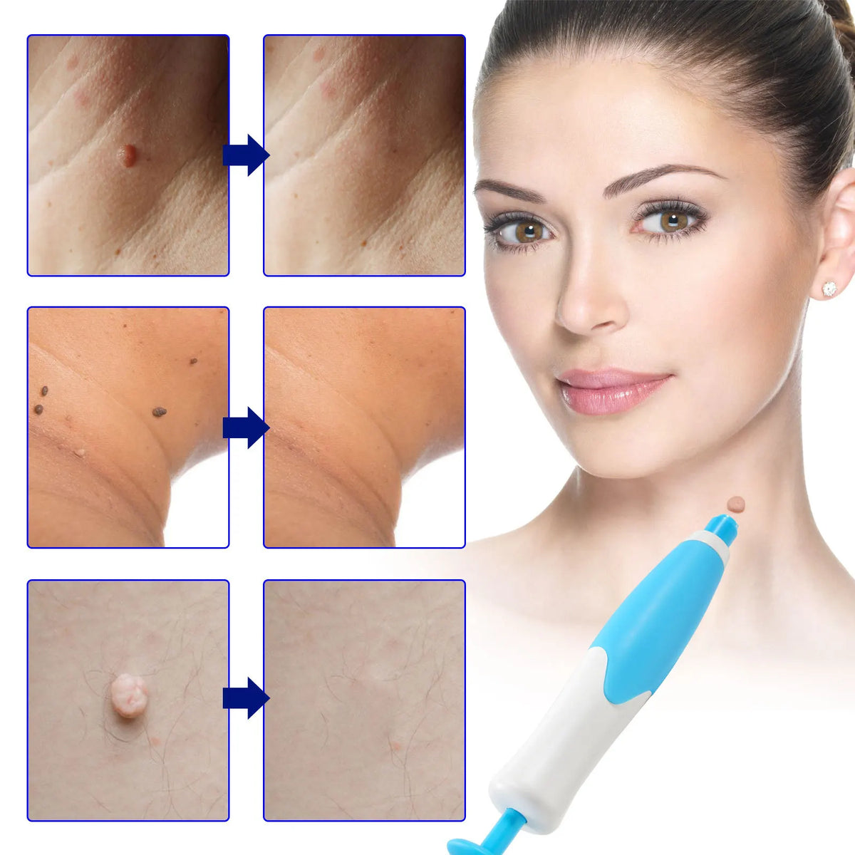Skin Spot Removal Kit Painless Applicator Silicone Bands