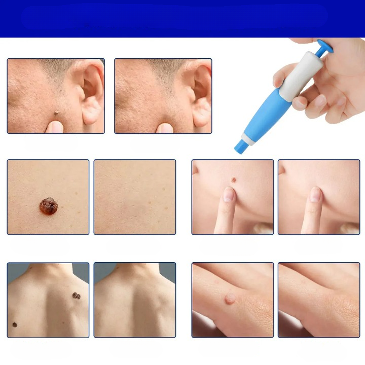 Skin Spot Removal Kit Painless Applicator Silicone Bands
