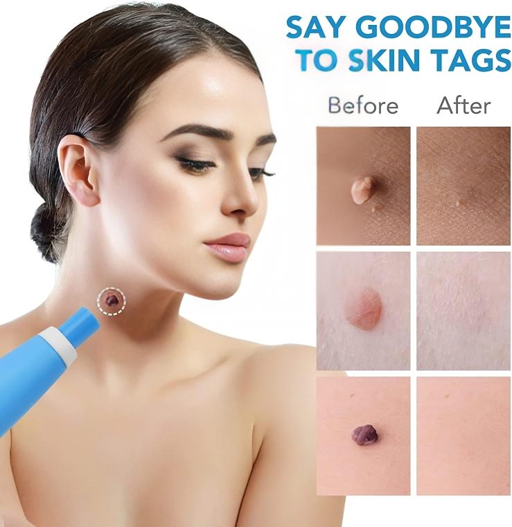 Skin Tag Remover Silicone Band Painless Face & Body