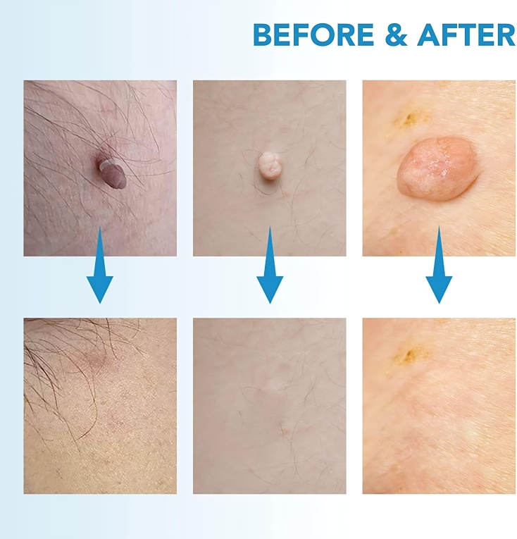 Skin Tag Remover Silicone Band Painless Face & Body