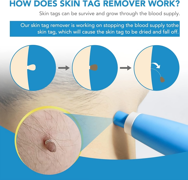 Skin Tag Remover Silicone Band Painless Face & Body