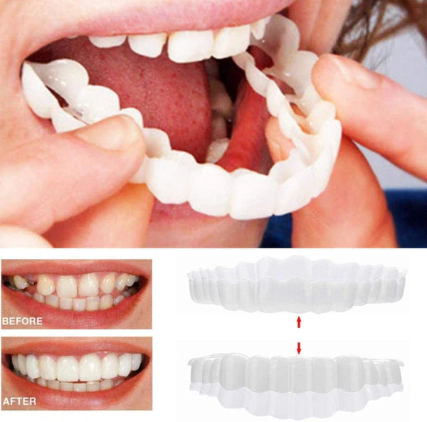 Snap-On Veneers Ultra-Thin Acrylic Upper & Lower Set