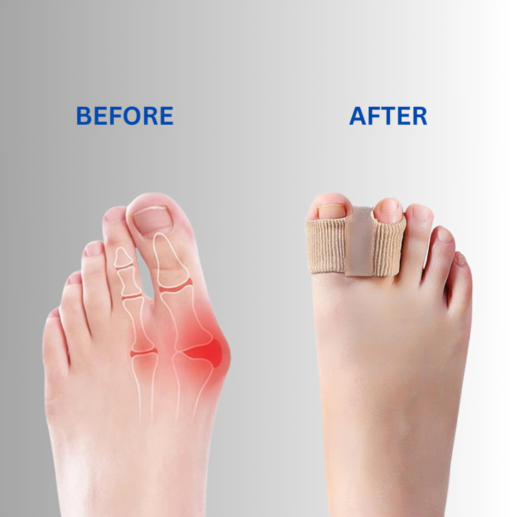 Toe Protection Pads Skin-Colored Silicone Set of 4