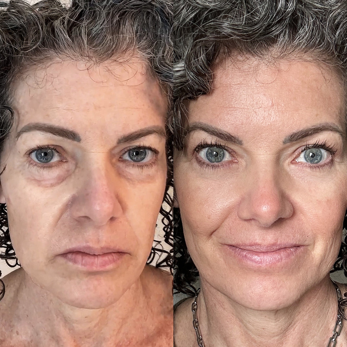 Under-Eye Device Red Light & Microcurrent Brightens & Firms