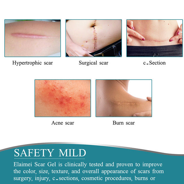 Advanced Silicone Scar Treatment Roll for Smooth Skin