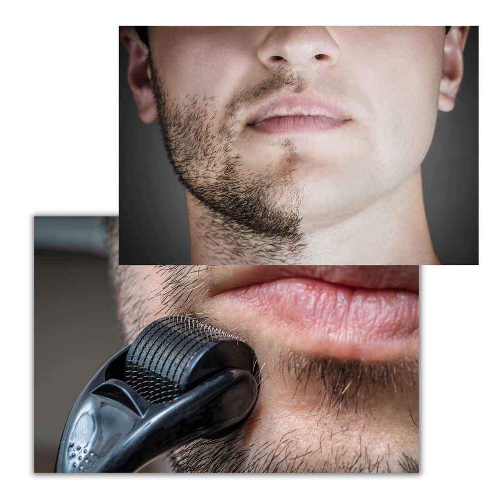 Revitalizing Microneedle Roller for Hair and Beard Enhancement
