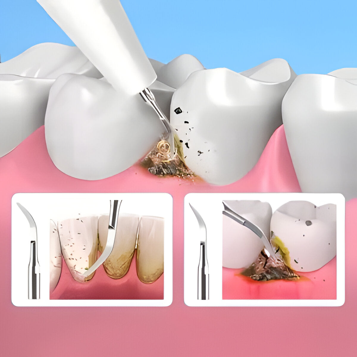 Advanced Ultrasonic Tooth Stain Remover