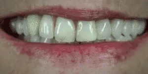 SmileWise | Custom Fit Snap-On Teeth Veneers for a Flawless Smile