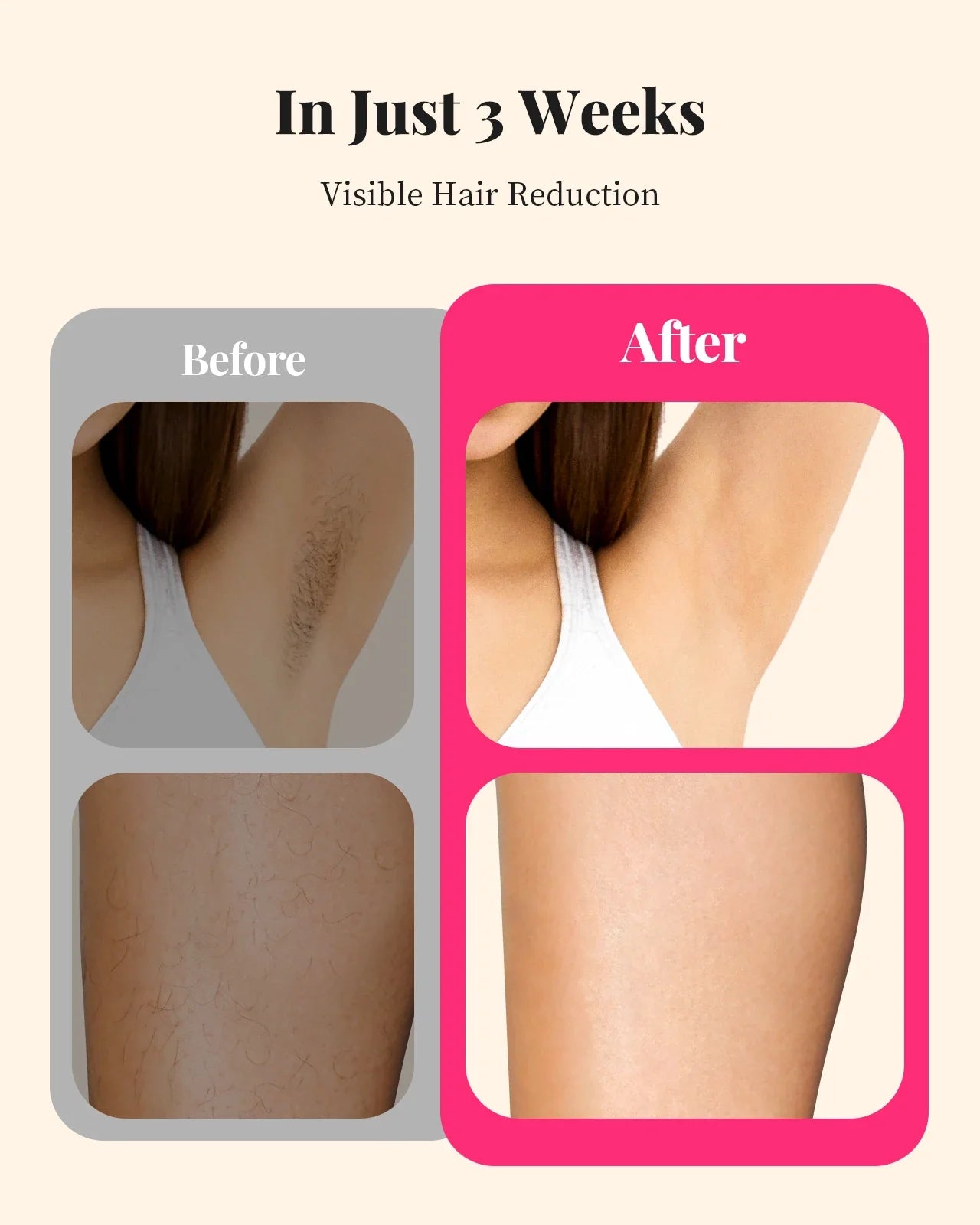 LuminEase IPL Hair Removal System with 990,000 Flashes – At-Home Hair Remover for Face & Body with Trimmer Accessory