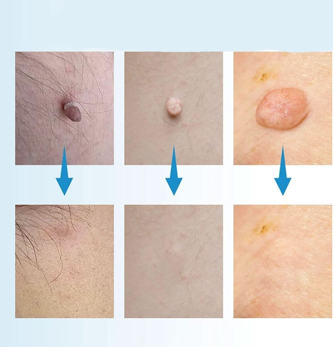 ClearSkin – Compact Precision Spot Treatment Device