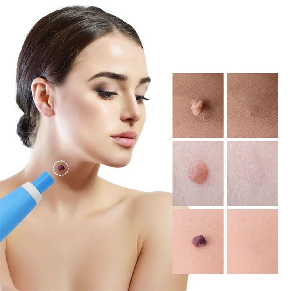 ClearSkin – Compact Precision Spot Treatment Device