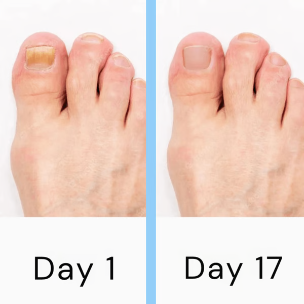Home Nail Therapy Laser Device for Fungal Treatment