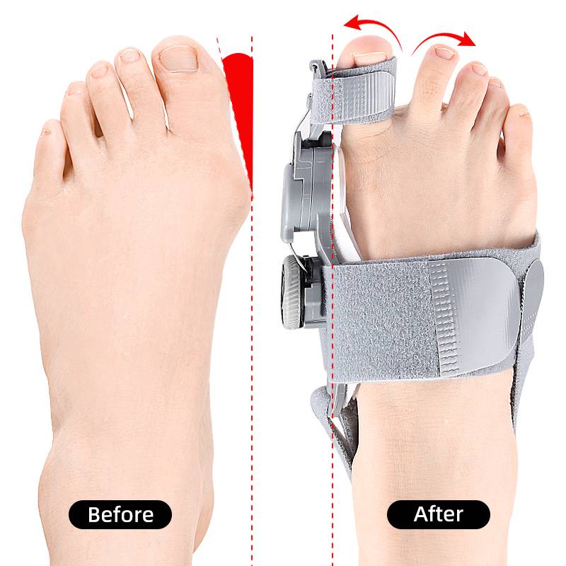 ComfortAlign Bunion Relief Toe Spacer