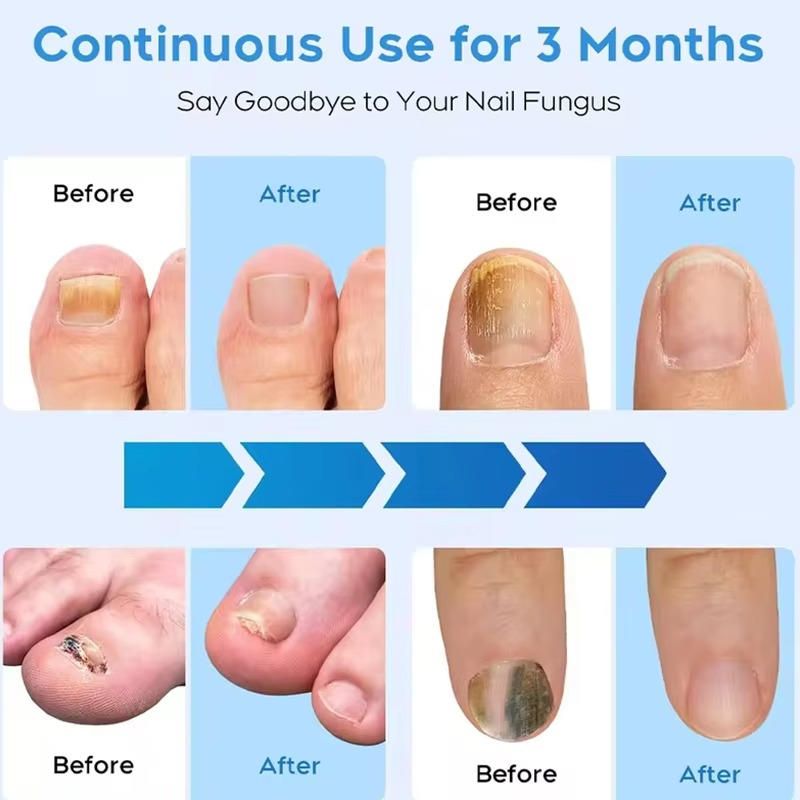 Nail Renewal Light Therapy System