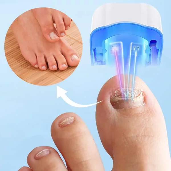 Laser Therapy Device for Healthier Nails