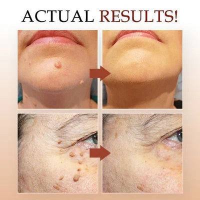 Skin Growth Eliminator for Home Use
