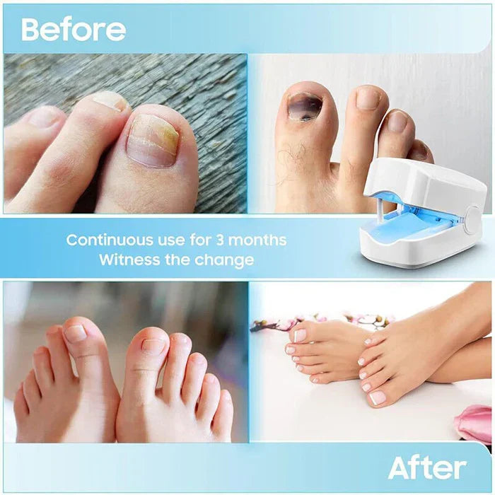 Laser Nail Care Solution - Effective Light Therapy for Fungal Treatment