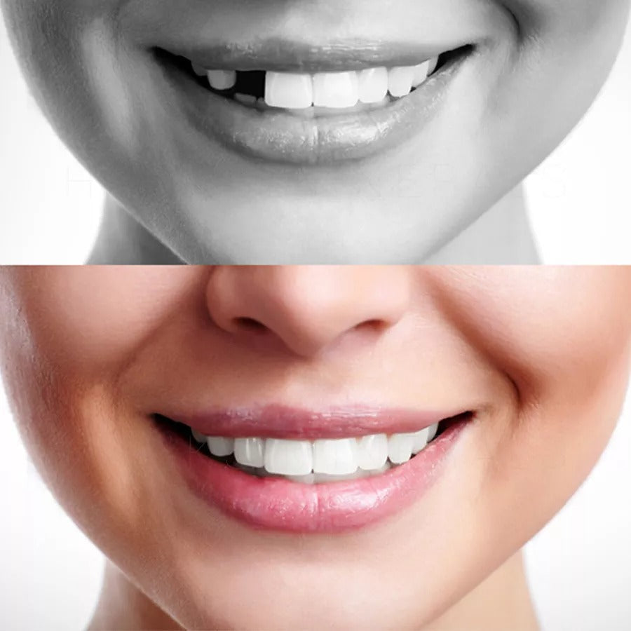 Custom Fit Dental Repair Kit for Missing Teeth