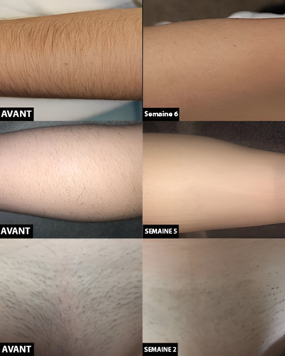 At-Home Laser Hair Removal System